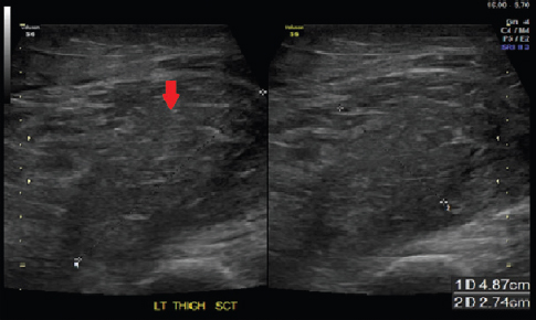 Ultrasound image of the left thigh showing hypoechoeic and enlarged adductor muscle (red arrow).